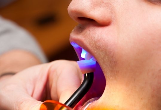 Dental patient heading ultraviolet light shone on tooth during direct bonding procedure