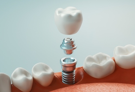 Illustrated dental implant in Farmington Hills with dental crown