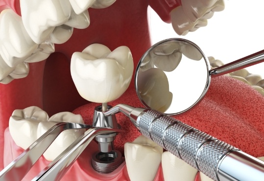 Illustrated dental implant with crown being placed into the lower jaw