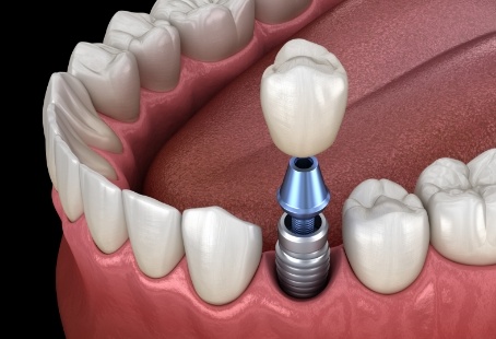Dental crown being placed onto dental implant