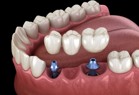 Dental bridge being placed onto two dental implants