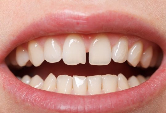 Gap between front teeth