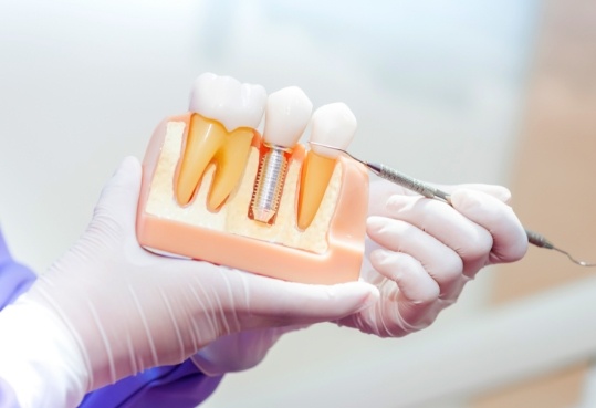 Dentist holding a model of a dental implant and crown in the lower jaw