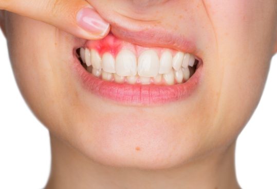 Person pointing to red spot in their gums