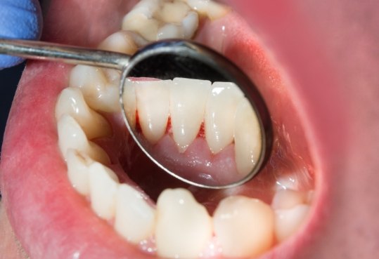 Close up of dental mirror in mouth showing red spot in gums