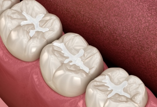 Close up of illustrated teeth with barely noticeable tooth colored fillings