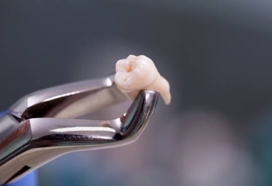 Dental forceps holding a tooth after tooth extraction in Farmington Hills
