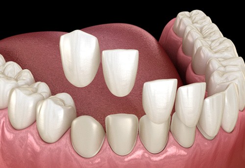 Illustration of veneers being placed on bottom, front teeth